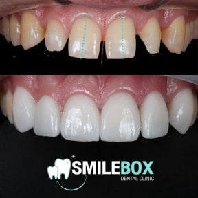 Vorher-nachher-Ergebnisse Zahnprothese bei SmileBox Dental Clinic - Thonglor, Sukhumvit Branch