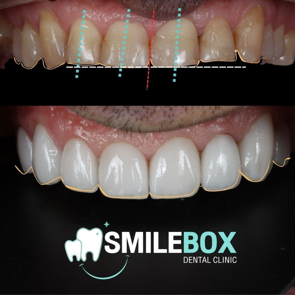 Resultados antes y después de carillas dentales en SmileBox Dental Clinic - Thonglor, Sukhumvit Branch