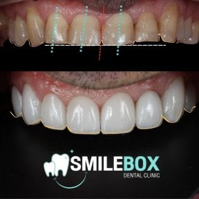 Vorher-nachher-Ergebnis Veneers bei SmileBox Dental Clinic - Thonglor, Sukhumvit Branch
