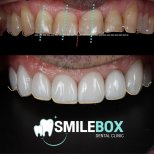Vorher-nachher-Ergebnis Veneers bei SmileBox Dental Clinic - Thonglor, Sukhumvit Branch