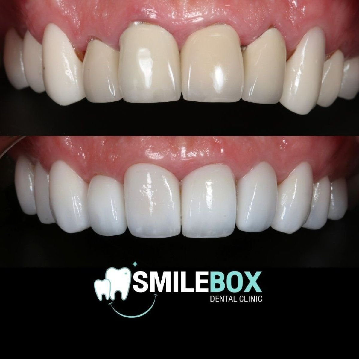 نتائج طقم الأسنان قبل وبعد في SmileBox Dental Clinic - Thonglor, Sukhumvit Branch