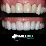 Vorher-nachher-Ergebnis Zahnprothese bei SmileBox Dental Clinic - Thonglor, Sukhumvit Branch