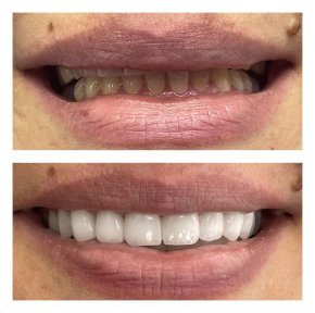Before and after veneers at Nifa Dent International – smile transformation results