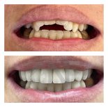 Before and after veneers at Nifa Dent International – smile makeover with natural results