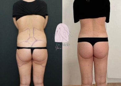 Before and after liposuction results on 5 body areas at Dr. MED, visible body contouring