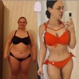 Before and after liposuction (5 body areas) result at Dr. MED – visible body contouring