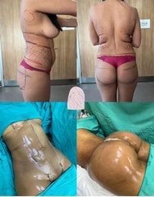 Before and after liposuction (5 body areas) results at Dr. MED – visible body contouring