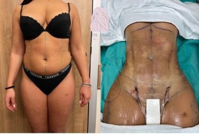Before and after liposuction results for 5 body areas at Dr. MED clinic, visible contour change