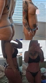 Before and after liposuction (5 body areas) result at Dr. MED – visible body contouring