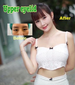 Before and after upper eyelid surgery results at ID Clinic Bangkok, improved eye appearance