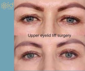 Before and after upper eyelid surgery results at ID Clinic Bangkok, eyelid lift improvement