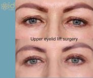 Before and after upper eyelid surgery results at ID Clinic Bangkok, eyelid lift improvement