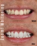 Результаты до и после отбеливания зубов в SmileBox Dental Clinic - Thonglor, Sukhumvit Branch