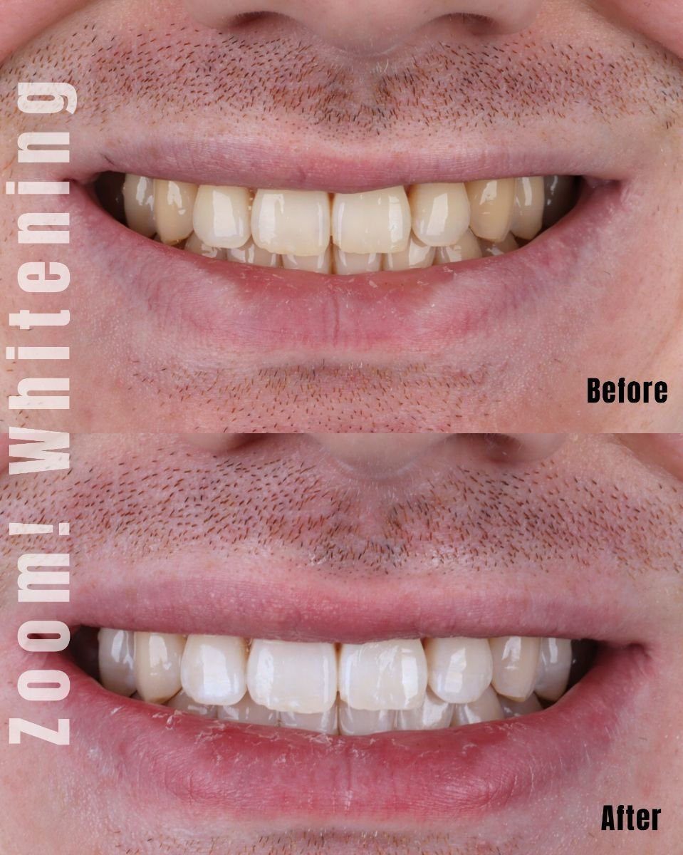 Resultados de blanqueamiento dental antes y después en SmileBox Dental Clinic - Thonglor, Sukhumvit Branch