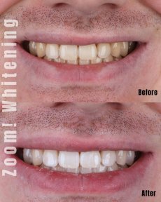 Результаты до и после отбеливания зубов в SmileBox Dental Clinic - Thonglor, Sukhumvit Branch