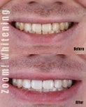 Результаты до и после отбеливания зубов в SmileBox Dental Clinic - Thonglor, Sukhumvit Branch