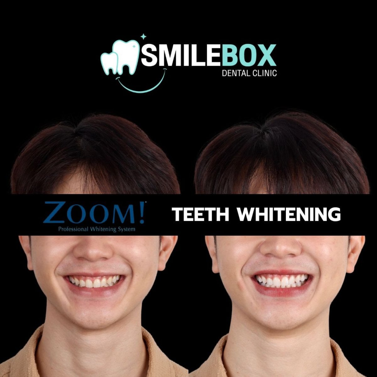 نتائج تبييض الأسنان قبل وبعد في SmileBox Dental Clinic - Thonglor, Sukhumvit Branch