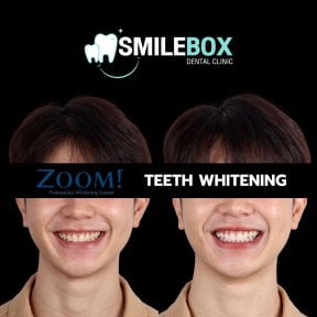 Результаты отбеливания зубов до и после в SmileBox Dental Clinic - Thonglor, Sukhumvit Branch