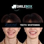 Результаты отбеливания зубов до и после в SmileBox Dental Clinic - Thonglor, Sukhumvit Branch