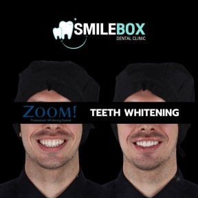 Результаты до и после отбеливания зубов в SmileBox Dental Clinic - Thonglor, Sukhumvit Branch