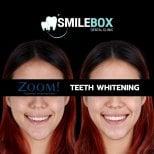 Результаты до и после отбеливания зубов в SmileBox Dental Clinic - Thonglor, Sukhumvit Branch