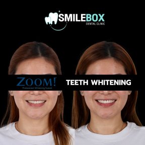 Результаты до и после отбеливания зубов в SmileBox Dental Clinic - Thonglor, Sukhumvit Branch