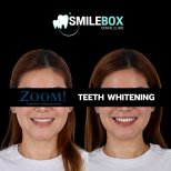 Результаты до и после отбеливания зубов в SmileBox Dental Clinic - Thonglor, Sukhumvit Branch
