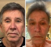 Facelift Vorher-Nachher-Ergebnisse in der Dr. Safa Manav Klinik, sichtbare Verjüngung