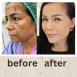 Facelift before and after results at ID Clinic Bangkok, visible facial rejuvenation outcome