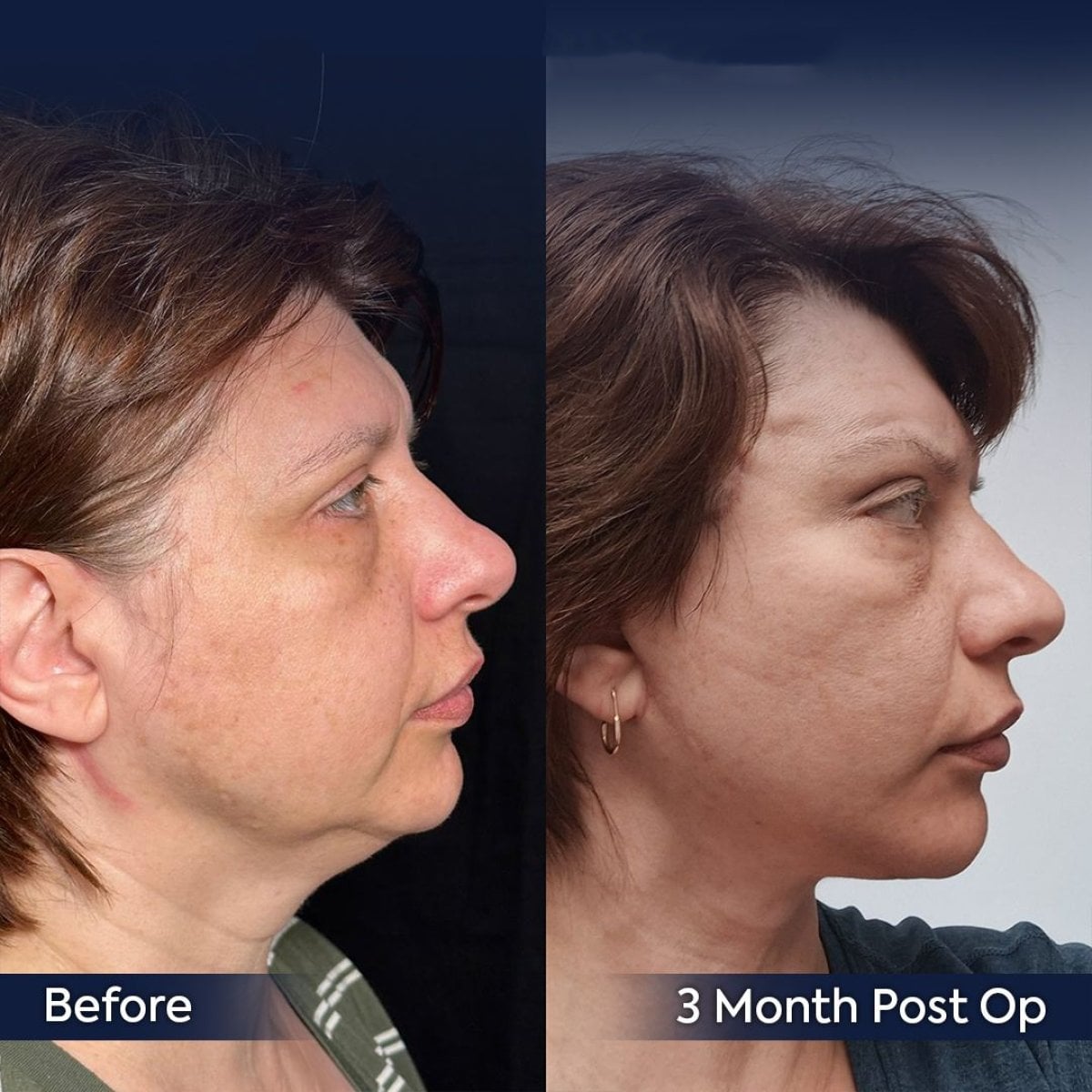 Resultados de lifting facial antes y después en Dr. Safa Manav Clinic, mejora del contorno