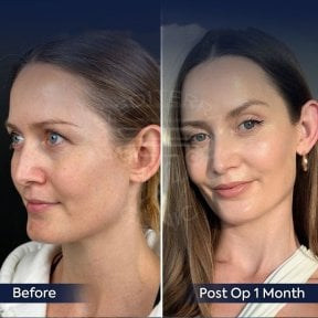 Facelift Vorher-Nachher-Ergebnisse in der Dr. Safa Manav Klinik, sichtbare Verjüngung