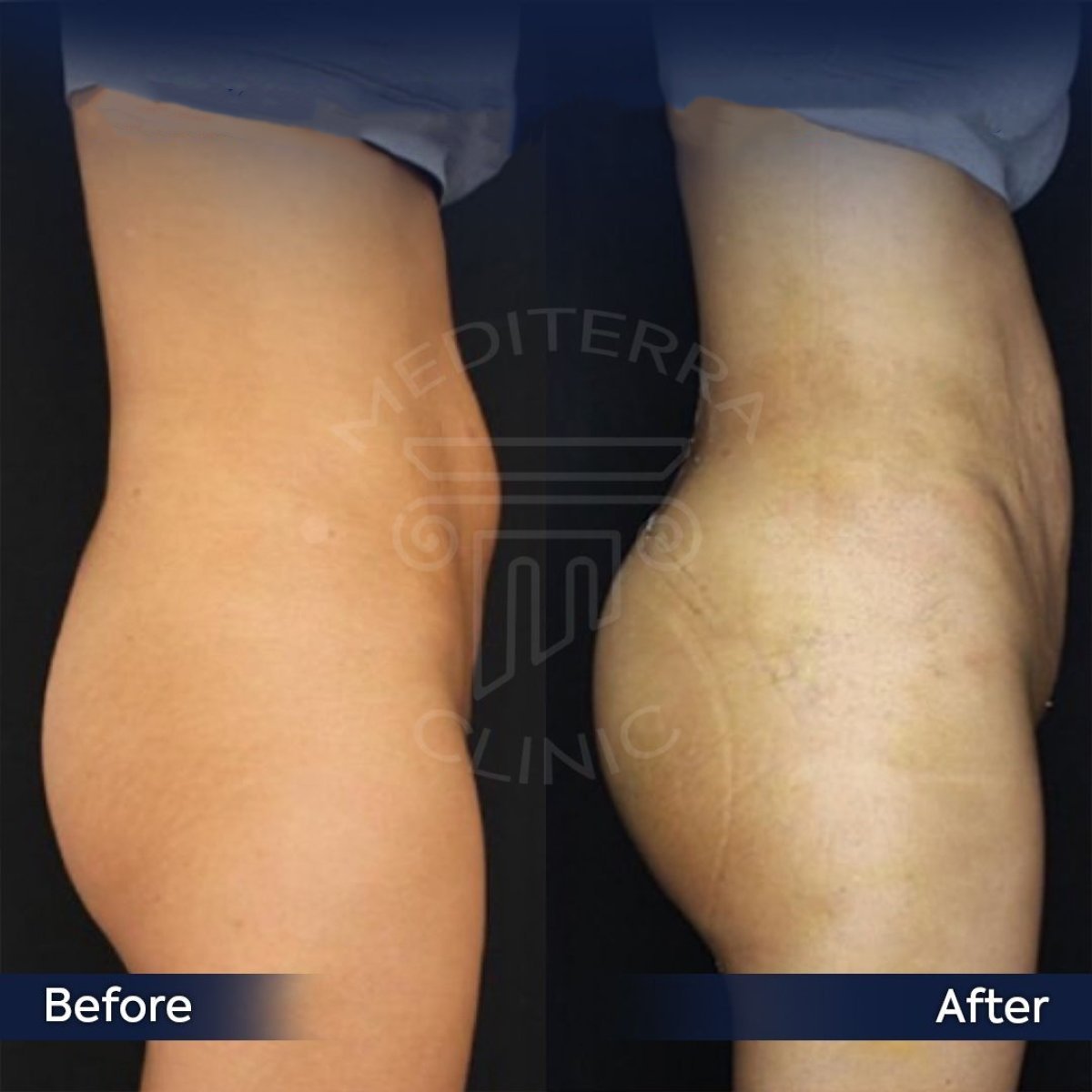 نتائج قبل وبعد زراعة المؤخرة في عيادة Dr. Safa Manav، تحسين شكل الأرداف