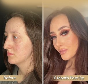 Vorher-nachher-Rhinoplastik-Ergebnis in der Dr. Safa Manav Klinik, 6 Monate postoperativ