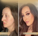 Vorher-nachher-Rhinoplastik-Ergebnis in der Dr. Safa Manav Klinik, 6 Monate postoperativ