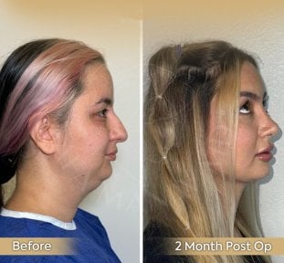Résultats avant/après rhinoplastie à la clinique Dr. Safa Manav, profil du nez amélioré
