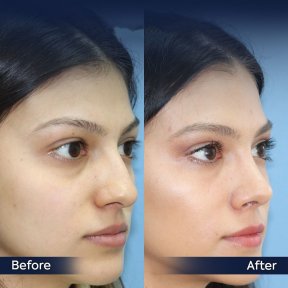 Vorher-nachher-Ergebnisse der Nasenkorrektur in der Dr. Safa Manav Klinik, natürliche Form