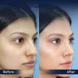 Vorher-nachher-Ergebnisse der Nasenkorrektur in der Dr. Safa Manav Klinik, natürliche Form