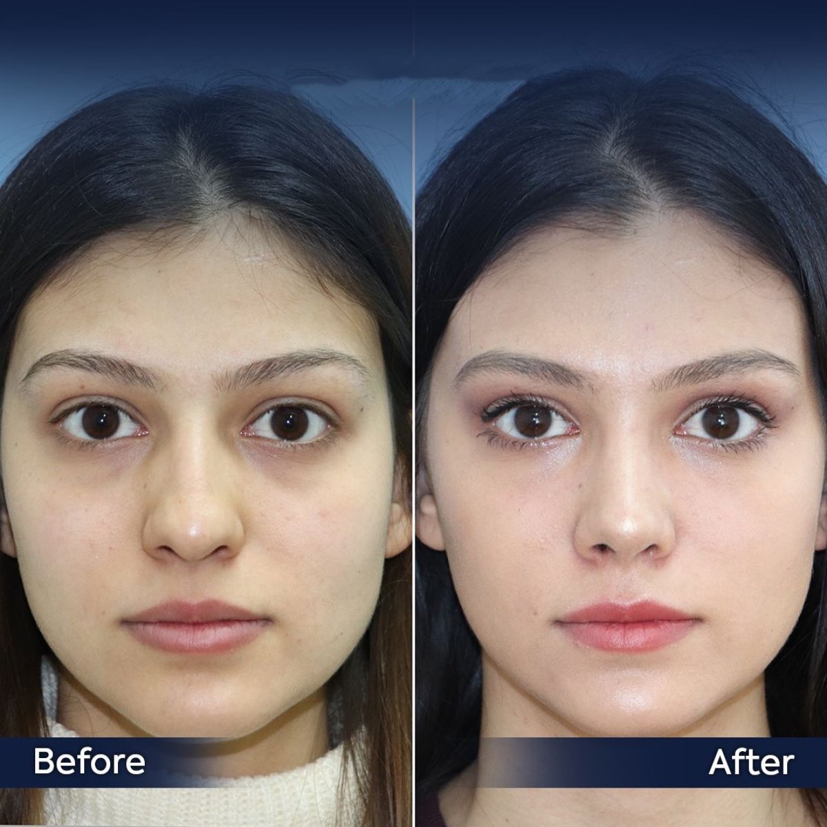 Resultados de rinoplastia antes y después en Dr. Safa Manav Clinic, mejora de la nariz