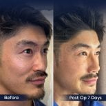 Efekty przed i po rhinoplastyce w Dr. Safa Manav Clinic, korekta nosa w 7 dni