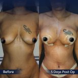 Before and after breast lift results at Dr. Safa Manav Clinic, 5 days post-op improvement