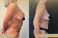 Before and after breast lift results at Dr. Safa Manav Clinic, improved breast contour visible