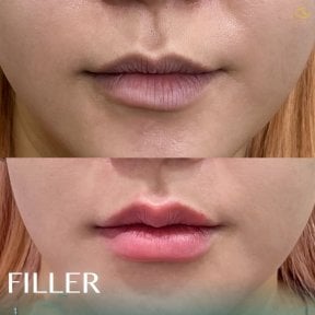 До и после увеличения губ филлерами в Anjali Clinic, результат объема и контура