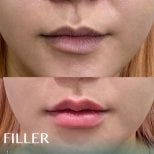 До и после увеличения губ филлерами в Anjali Clinic, результат объема и контура