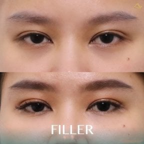 До и после инъекций филлеров в Anjali Clinic, видимый результат под глазами