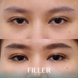 До и после инъекций филлеров в Anjali Clinic, видимый результат под глазами