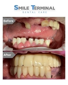 Before and after All-on-4 dental implants result at Smile Terminal Dental Care, full smile restoration