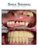 Before and after All-on-4 dental implants result at Smile Terminal Dental Care, full smile restoration