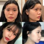Vorher-nachher-Ergebnis der Jochbeinreduktion bei VG Plastic Surgery, sichtbare Konturverbesserung
