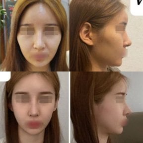 Vorher-nachher-Ergebnis der Jochbeinreduktion bei VG Plastic Surgery, verbesserte Gesichtskontur