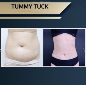 Before and after tummy tuck results at Asia Cosmetic Hospital, visible abdominal contour improvement